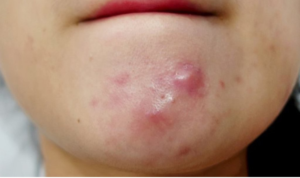 Spa Điều Trị Mụn Bọc:1 Giải Pháp Hiệu Quả Cho Làn Da Sáng Mịn 2 screenshot 1723728313